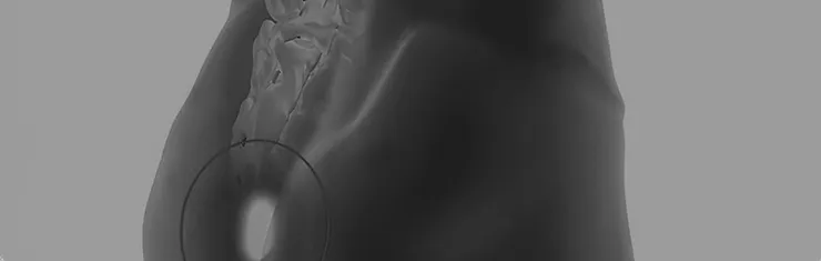 Pilonidotomia a laser de energia mínima (MELPi): um estudo multicêntrico de um novo método na doença pilonidal
